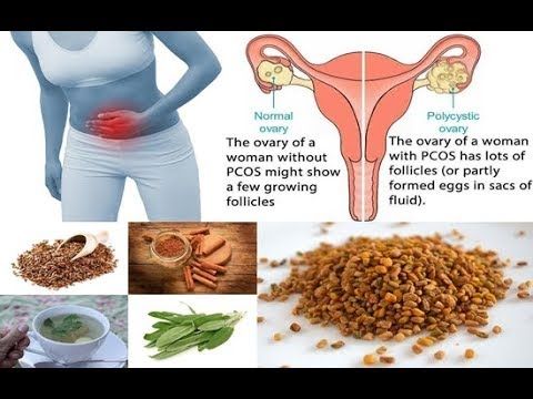 Managing Polycystic Ovary Syndrome (PCOS) Naturally